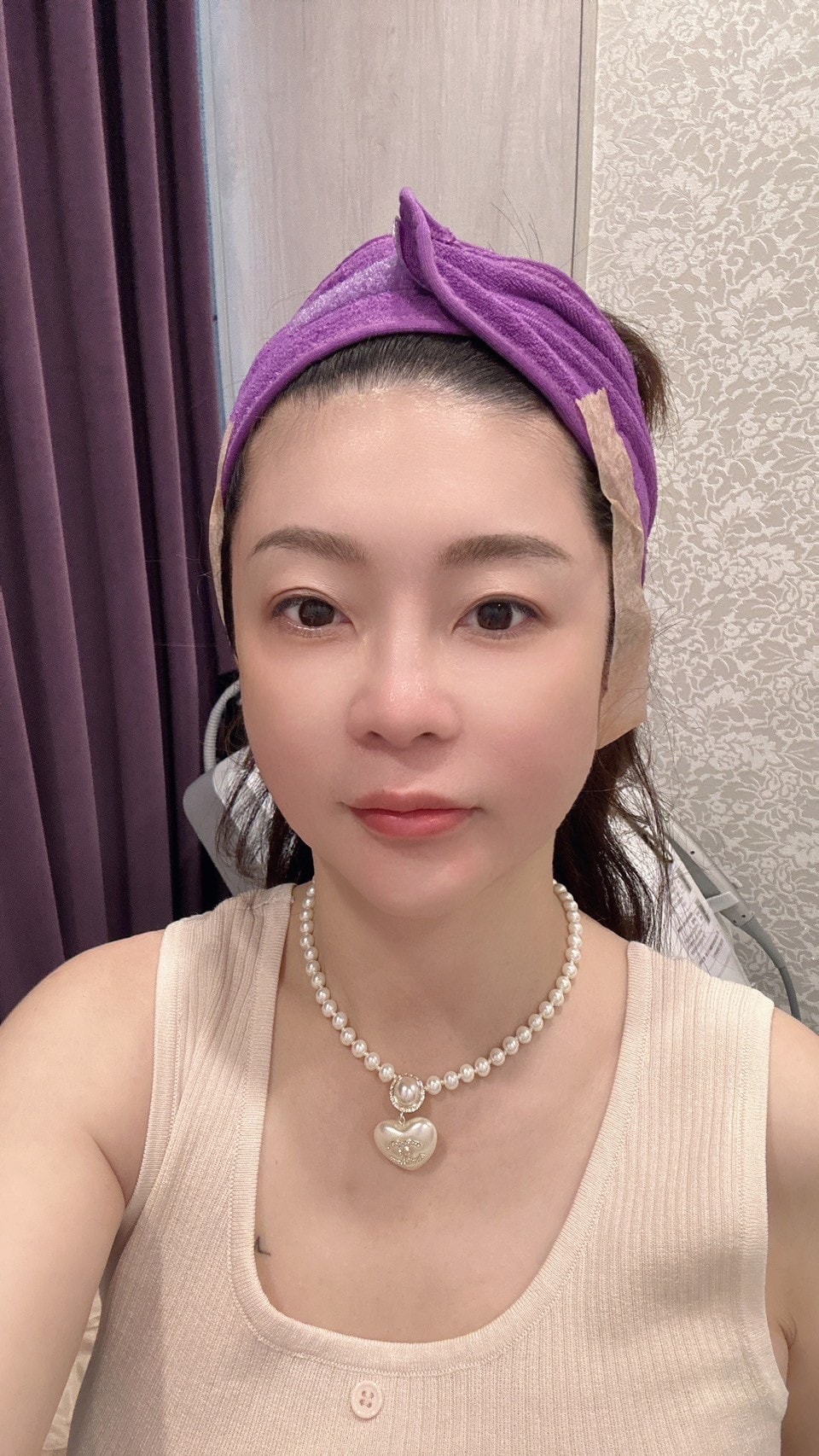 【台中Z音波】佳思優整形外科美學診所│法令木偶紋消去法,中下臉提拉更快速有感 - 第18張圖
